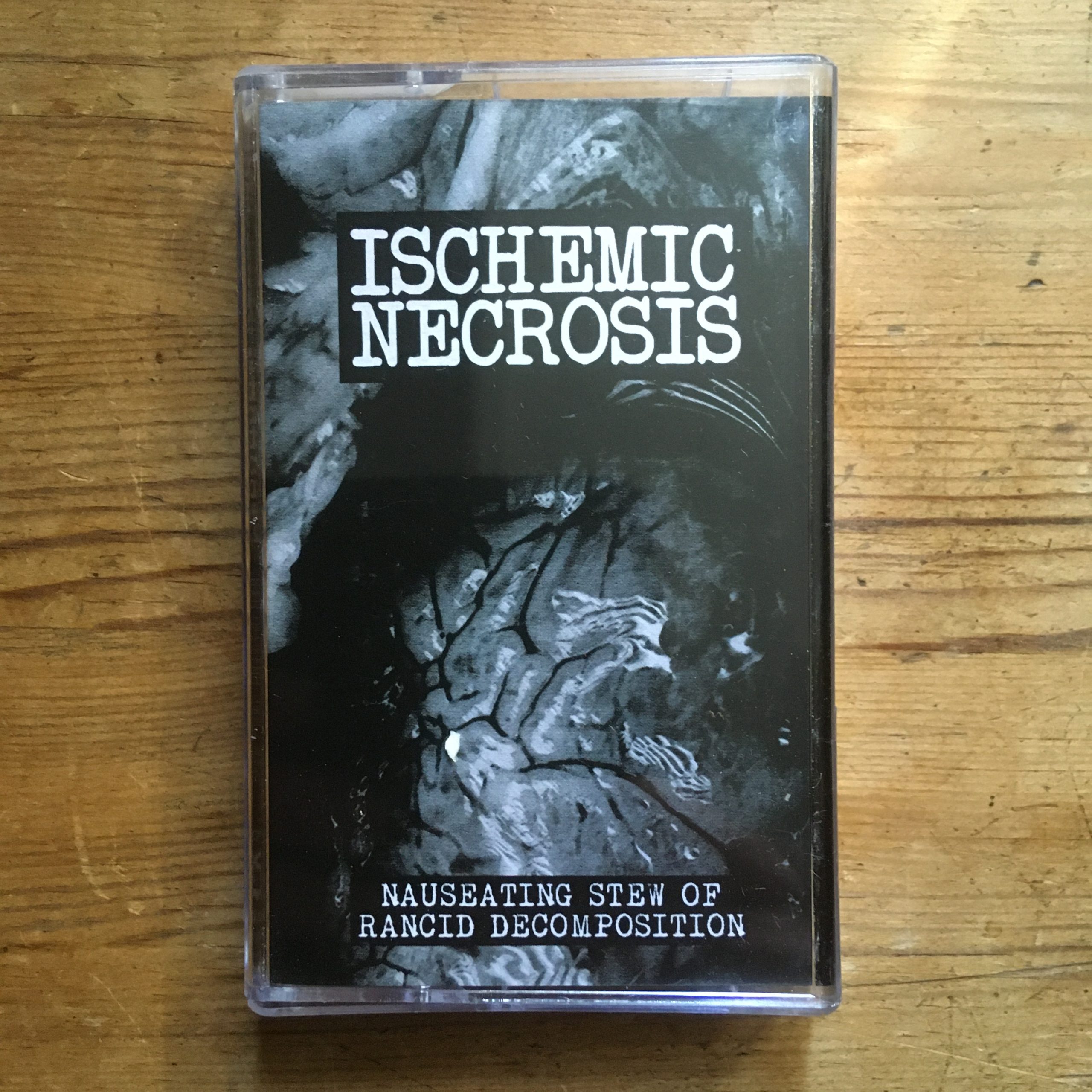 Photo of the Ischemic Necrosis - "Nauseating Stew Of Rancid Decomposition" MC